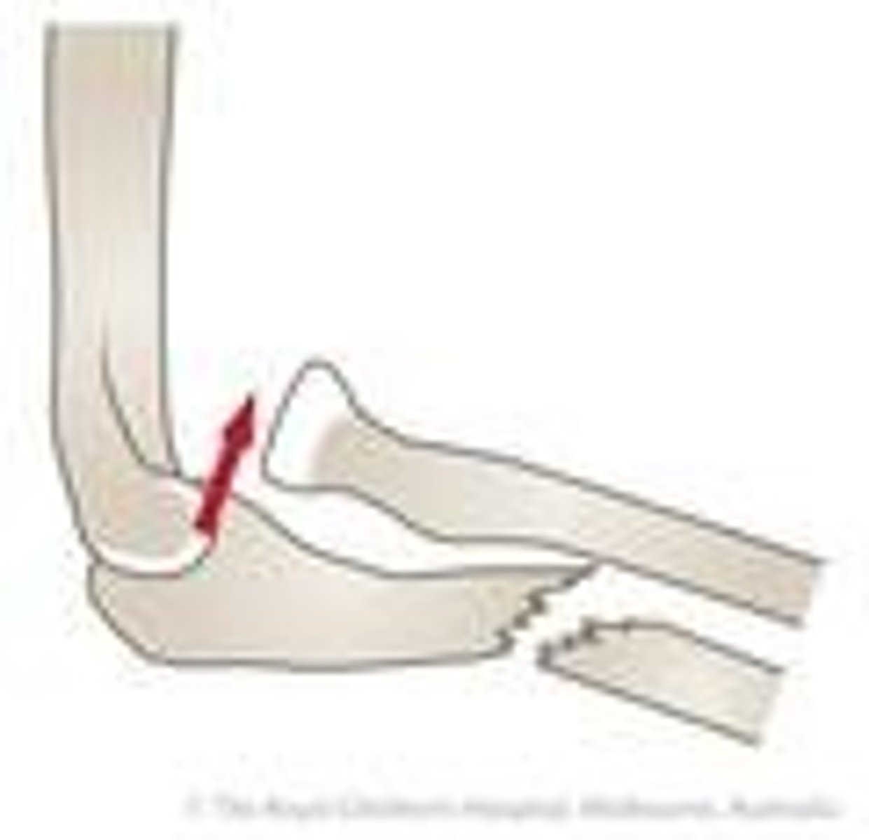 <p>A fracture of the distal third of the radial shaft with dislocation of the distal radioulnar joint.</p>