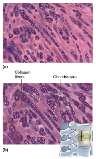 <p>Parallel collagen fibers similar to those of tendon; rows of chondrocytes in lacunae between collagen fibers; never has a perichondrium</p>