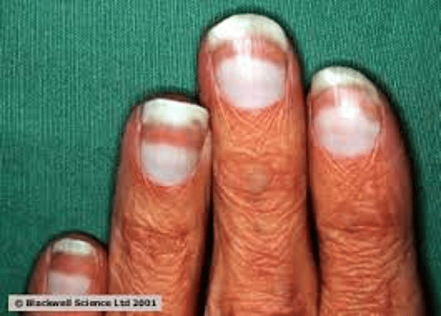 <p>Pallor from anemia</p><p>Terrys nails</p><p>Hypertension</p><p>Uremic frost</p>