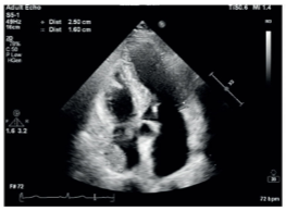 <p>Benign, fatty tumor that grows within the heart muscle or pericardium.</p><p>Usually solitary.</p><p>Most commonly found in LV, RA, and IAS.</p>