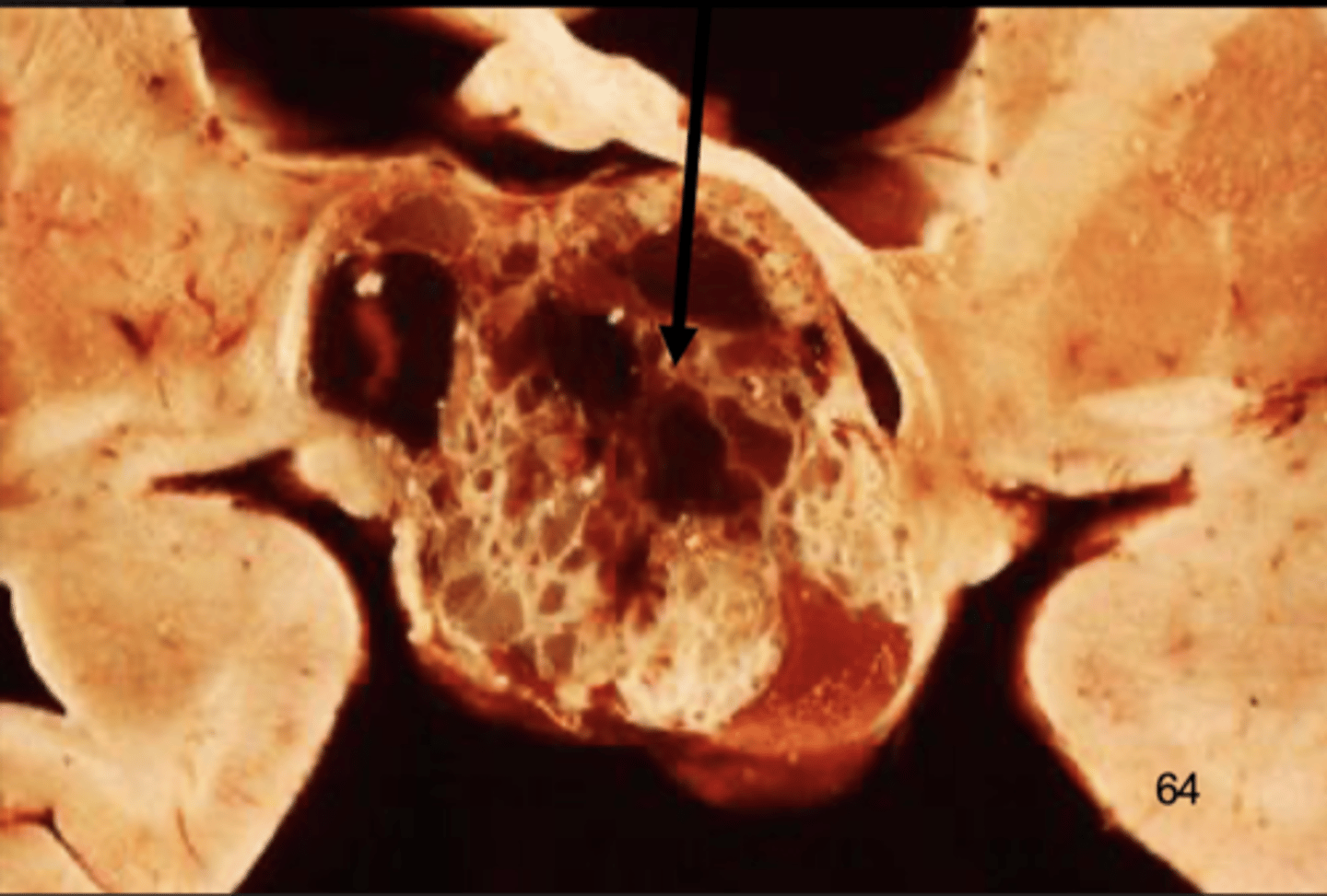 <p>cystic, "motor-oil" fluid filled</p><p>areas of calcification</p>