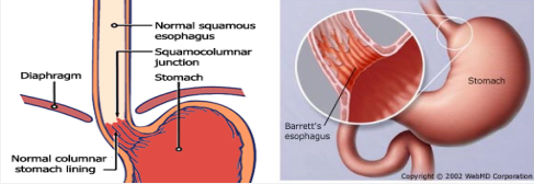 <p><strong>Barrett’s Esophagus: Background</strong></p><p>-________ change d/t chronic GERD, predisposes to ______________</p><p>-Epidemiology → more common in white males, mean age at dx is 55</p><p>-Pathophysiology → chronic GERD causes a metaplastic change, d/t inflammation, in the ______ esophagus from normal stratified squamous epithelium to a more acid-resistant _______ epithelium</p><p>-Symptoms → Barrett’s esophagus itself is ____________, usually found during investigation of ____ symptoms </p>