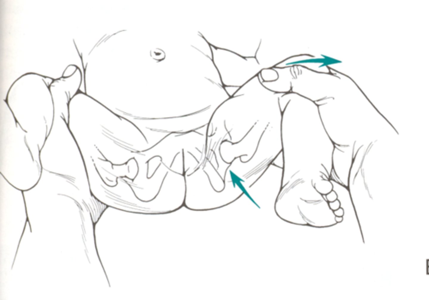 <p>Confirm hip dislocation</p><p>Abduct both hips simultaneously</p>