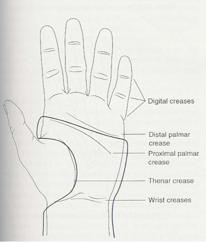 <p><span>•Better patterns lead to well-fitting orthoses and more efficient fabrication</span></p><p><span>•Use anatomical landmarks to create pattern</span></p><p><span>•Cut out pattern, try on client, make modifications</span></p><p><span>•Draw pattern onto thermoplastic material (one scissor width away from pattern to allow for cutting</span></p>