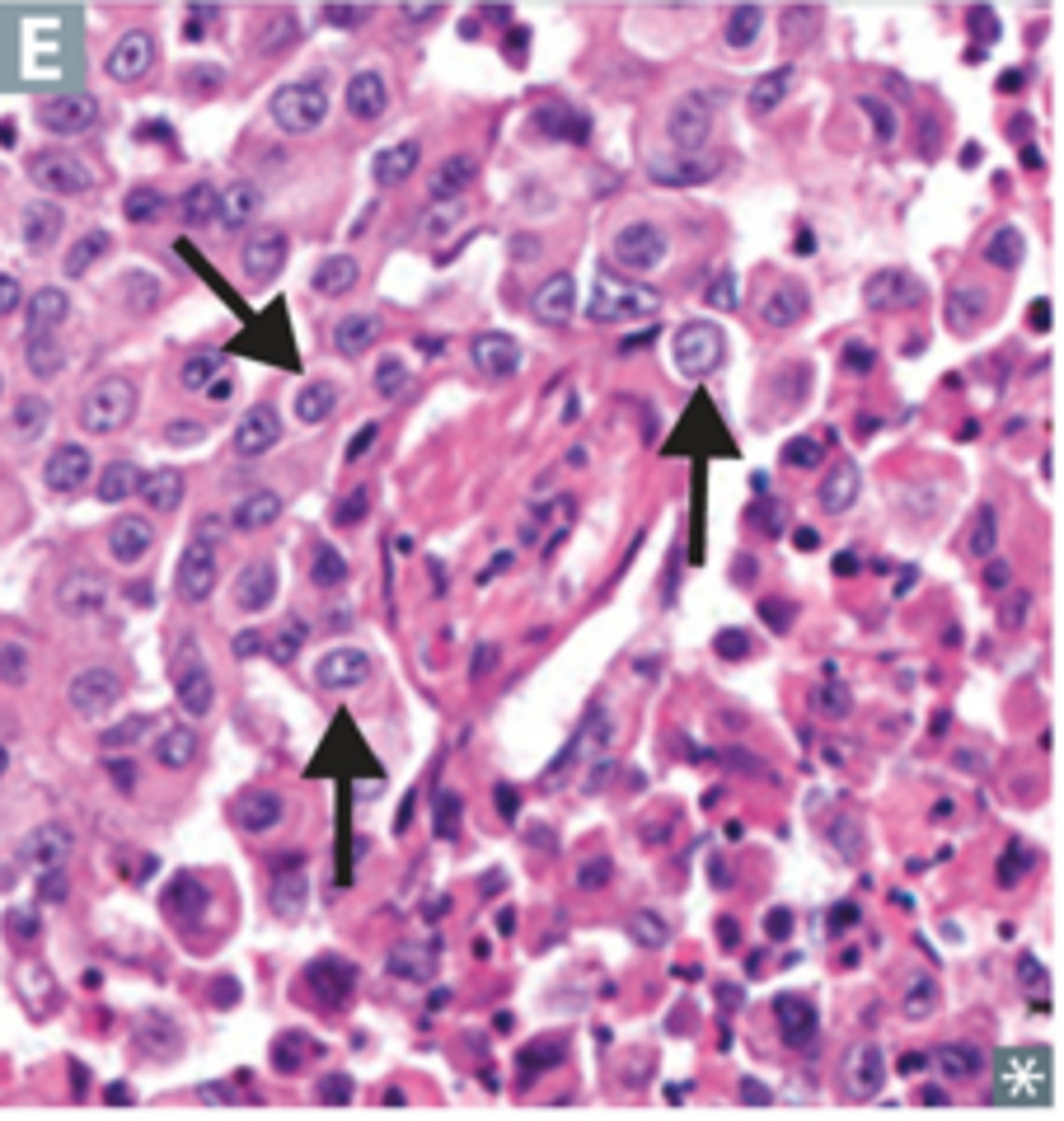 <p>Loss of normal tissue architecture, pleomorphic nuclei, high mitotic activity, and little or no tubule formation.</p>