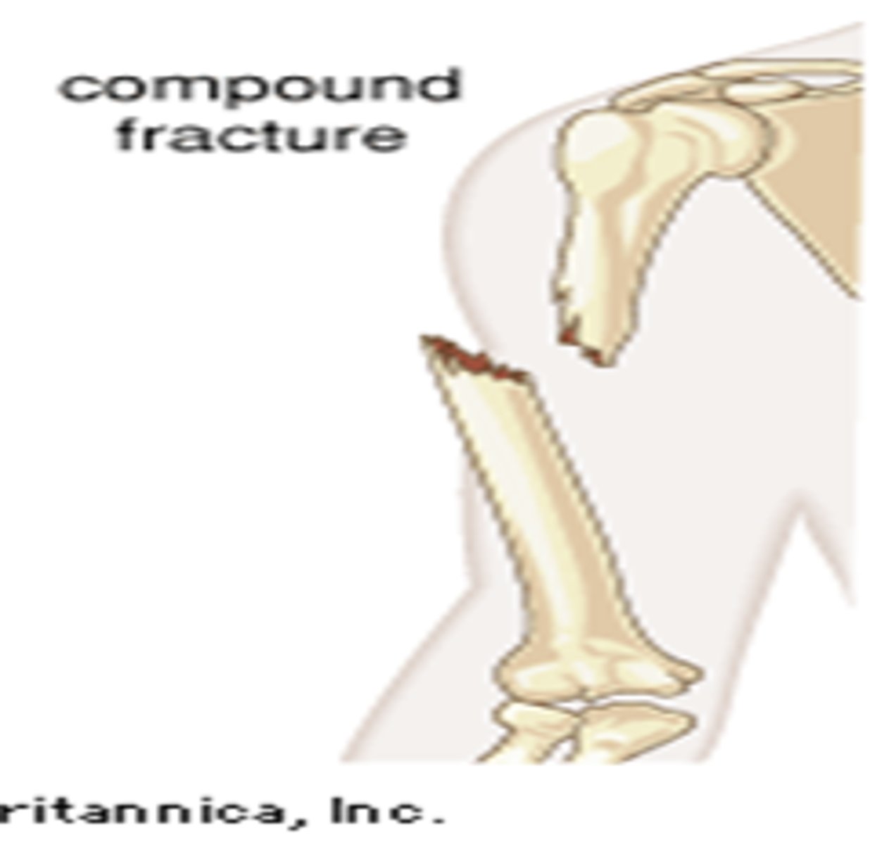 <p>type of fracture in which the broken bone penetrates the skin and is exposed to the outside of the body; also called open fracture</p>