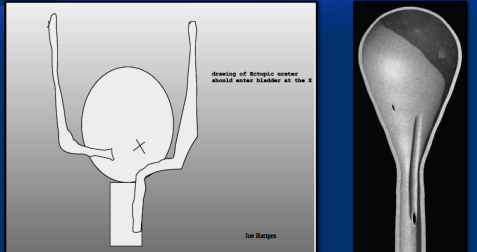 <ul><li><p><span style="background-color: transparent;"><strong>Sig: young(born with it)</strong>, females, Labs, Goldens, Huskies</span></p></li><li><p><span style="background-color: transparent;"><strong>Cs: </strong>constant or intermittent dribbling, recurrent UTIs</span></p></li><li><p><span style="background-color: transparent;"><strong>Dt: <u>cystoscopy, contrast CT</u></strong></span></p></li><li><p><span style="background-color: transparent;"><strong>Tx: cystoscopic laser ablatio</strong>n, neoureterostomy, ureteroneocystotomy, hydraulic occluder</span></p></li></ul><p></p>