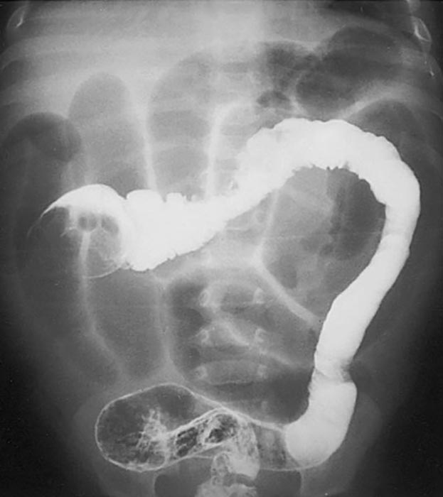 <p>Why is intussusception dangerous?</p>