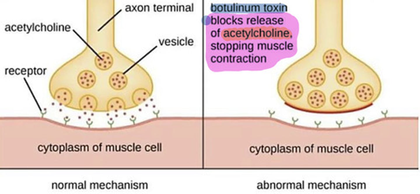 <p>Anything that prevents binding of ACh to receptors: 1) Botox prevents release of ACh 2) Any toxin that prevents binding of ACh t receptors</p>