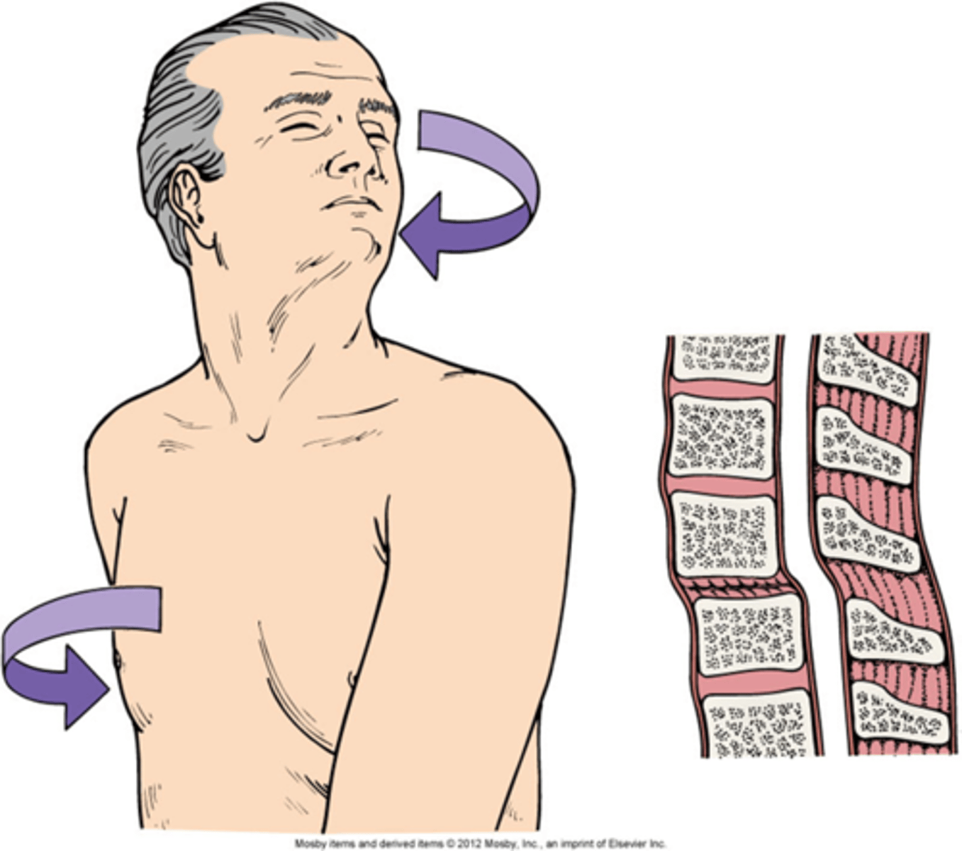 <p>Major Mechanisms of SCI:</p><p>- most unstable of all injuries</p><p>- ligamentous structures that stabilize spine are torn</p><p>- injury most often implicated in severe neuro deficits</p>