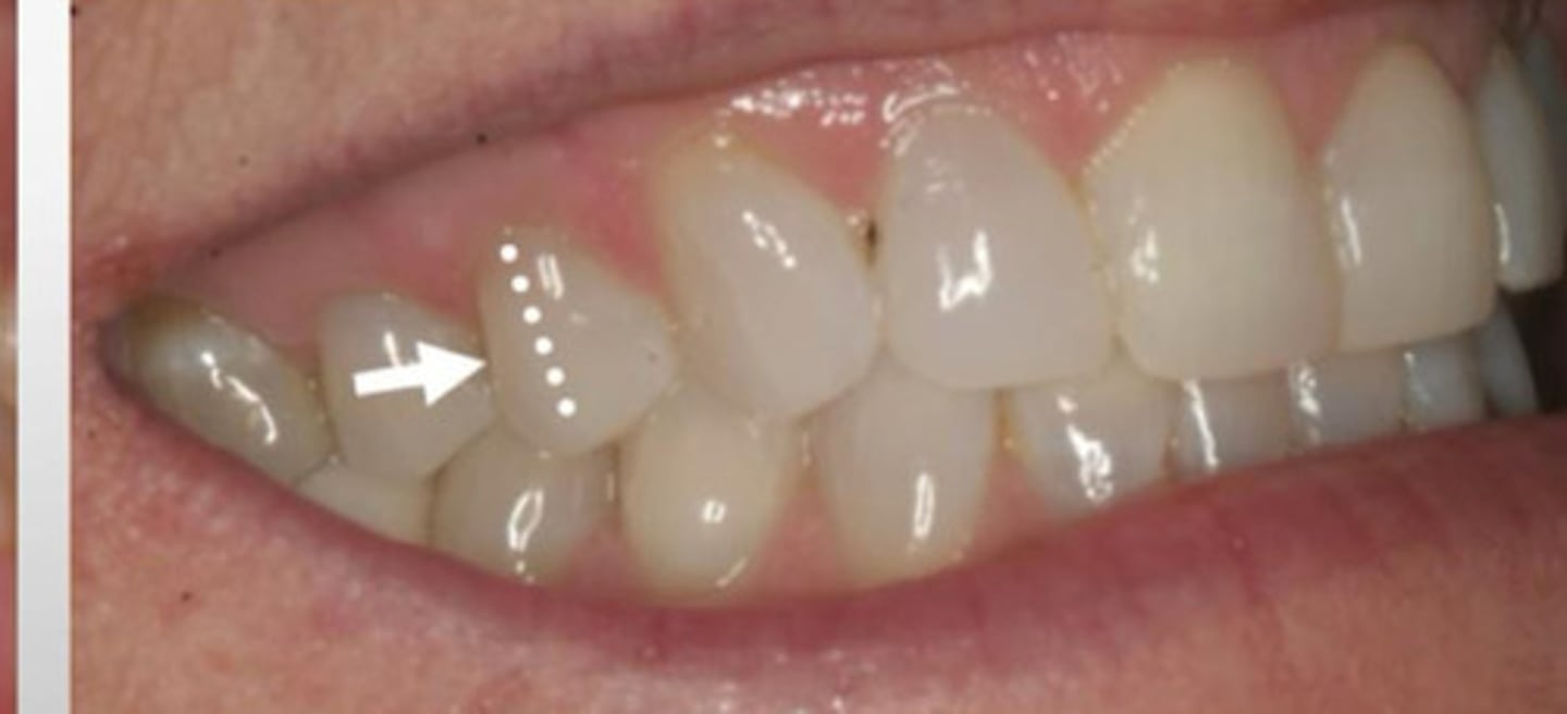 <p>a ridge running cervico-occlusally in approximately the center of the buccal surface of premolars</p>