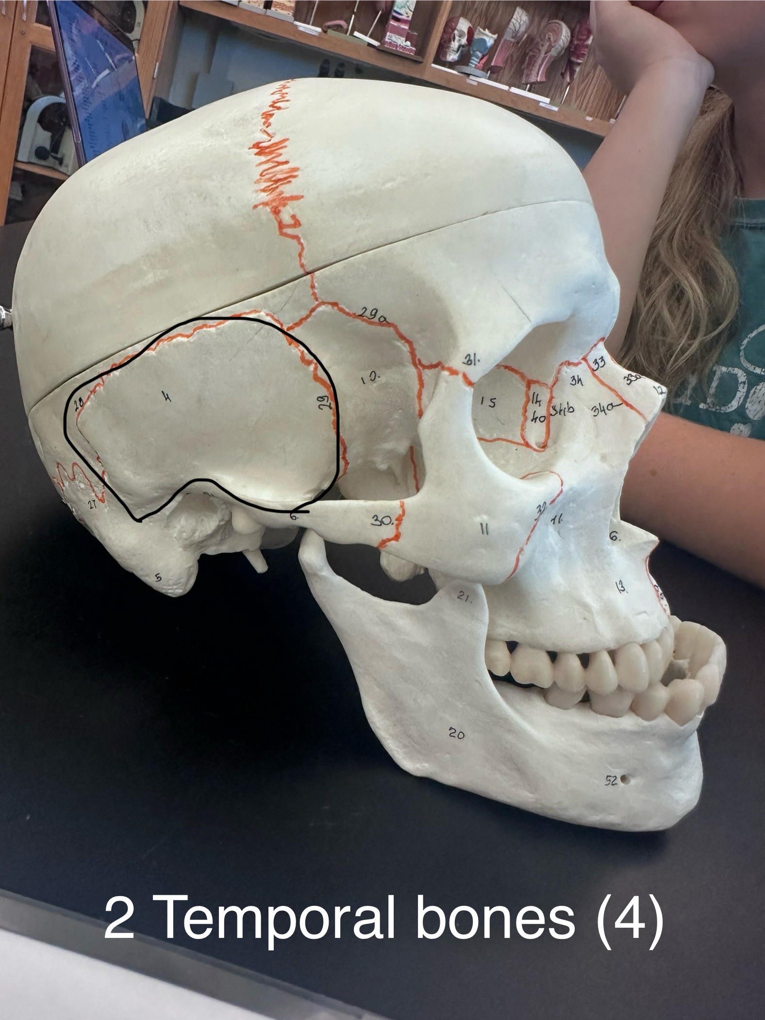 <p>Temporal Bones (2)</p>