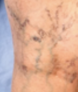 <p>Vascular Skin Lesion</p><ul><li><p><strong>Dilated veins and venules</strong> commonly found in the <strong>popliteal area</strong></p></li></ul><p></p>