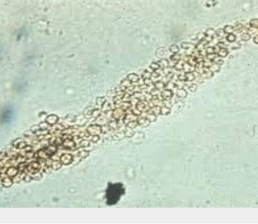 <p>RBC casts</p>