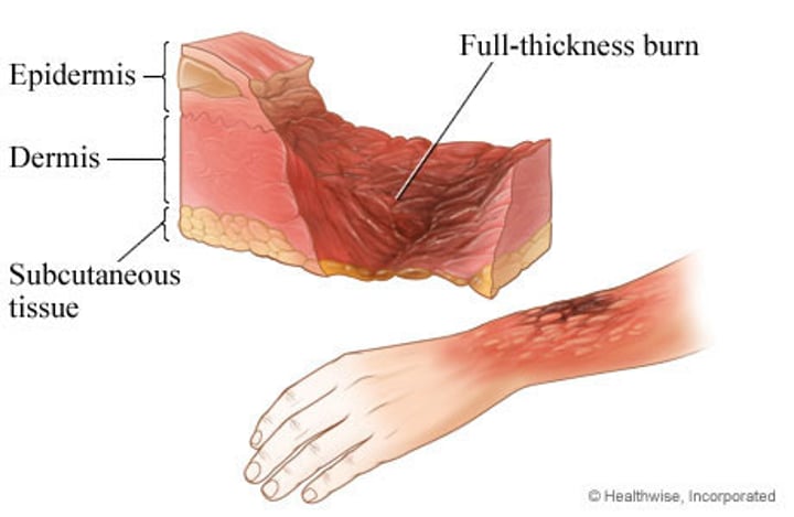 <p>•involve entire thickness of the skin</p><p>•Burned area appears gray-white, cherry red, or black, & there is no initial edema nor pain (since nerve endings are destroyed)</p>