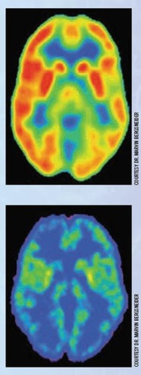 <p>Brain tumors and lesions, appearing darker on the scan.</p>