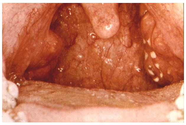 <p>history: patient complains of sore throat, fever, headache, nausea and vomiting</p><p>examination: redness, oedema, lymphoid hyperplasia, enlarged tonsils with exudate, enlarged tender lymph nodes, fever</p><p>lab findings: positive throat culture, immunological (antibody) response </p>