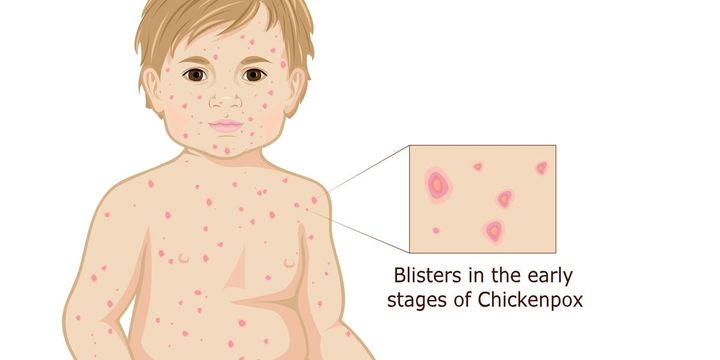 <p>More severe in older children and adults, highly contagious and airborne:</p><ul><li><p>Scarring</p></li><li><p>Blister-like rash</p></li><li><p>Redness</p></li><li><p>Pain</p></li><li><p>Fever</p></li><li><p>Respiratory Issues (later in life)</p></li><li><p><u>Complications</u>: encephalitis, bacterial skin infections, pneumonia, Reye syndrome, and death</p></li></ul><p></p>