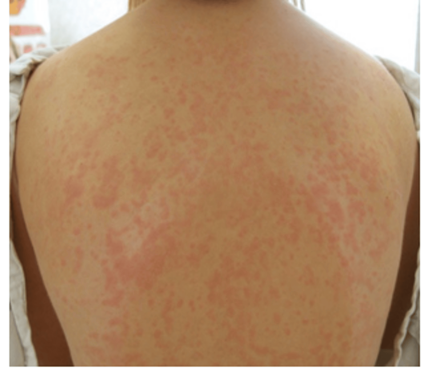 <p>afebrile patient with erythematous macules and papules that may itch across the whole body</p>
