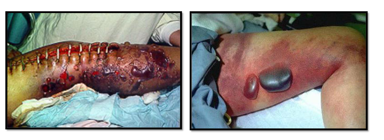 <ul><li><p><span><span>значителното намаляване на окислително-</span></span><br><span><span>редукционния потенциал на травматизираните тъкани, което дава</span></span><br><span><span>възможност за инвазивно размножаване на клостридиите и продуциране</span></span><br><span><span>на екзотоксини→</span></span><span>некроза,</span></p><p><span>оток и образуване на газ</span></p></li><li><p><span><span>газът се образува при ензимно разграждане на</span></span><br><span><span>въглехидратите, особено на гликогена в мускулите и на белтъците</span></span></p></li><li><p><span><span>тежко заболяване, което и днес има</span></span><br><span><span>висок леталитет</span></span><br><br></p></li></ul><p></p>