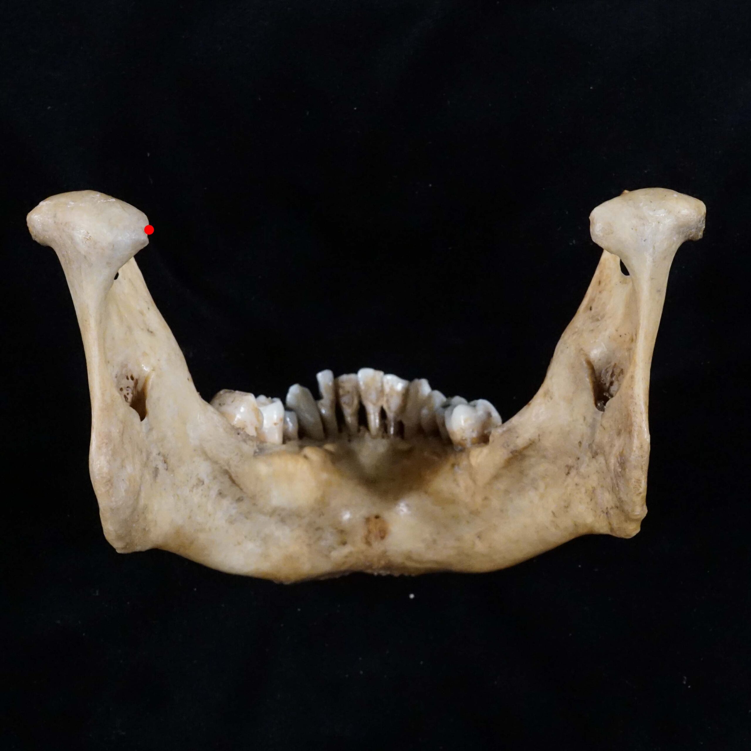 <p>Most medial point on mandibular condyle</p>