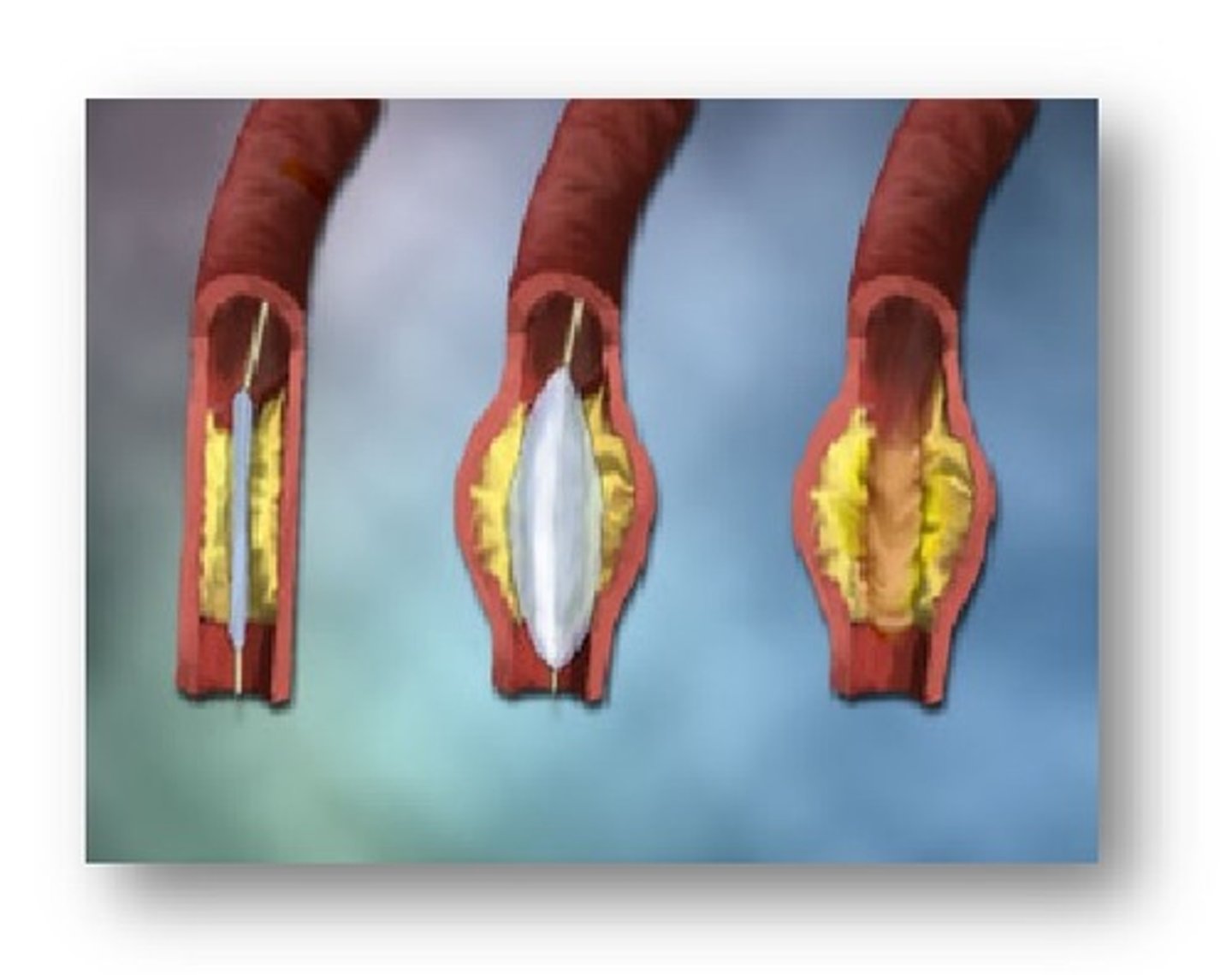 <p>- balloon/stent to restore coronary artery blood flow when arteries are narrowed or clogged. </p><p>- a femoral introducer/sheath </p><p>• Complications: hematoma, pseudoaneurysm, infection over femoral artery, kidney injury from contrast dye. Ask about allergies to iodine/shellfish</p>