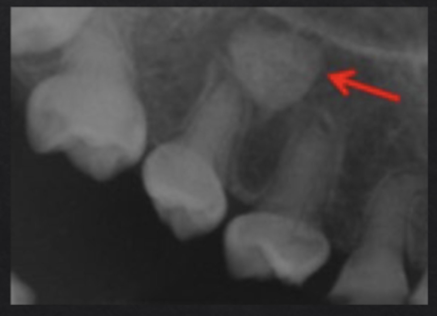 <p>"Dense bone island" an area where normal trabecular bone is replaced with dense cortical bone</p>