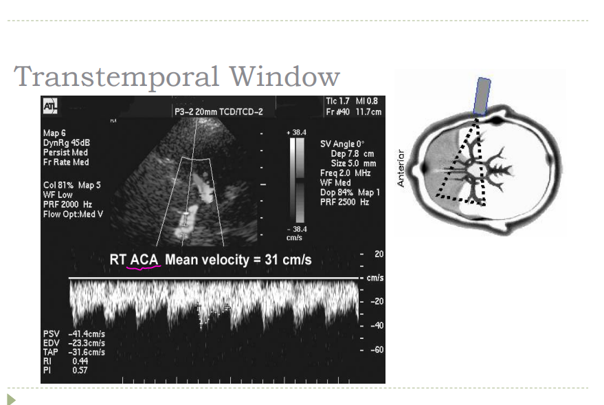 <p>Depth- 60-80 mm  </p><p>Flow direction – retrograde / away </p><p> ACA/MCA bifurcation toward and away (VT pg 242)  </p><p>Mean velocity- 50 + 11 cm/sec  </p><p>Decrease color PRF to visualize low velocity </p><p> Angle – anterior and superior</p>
