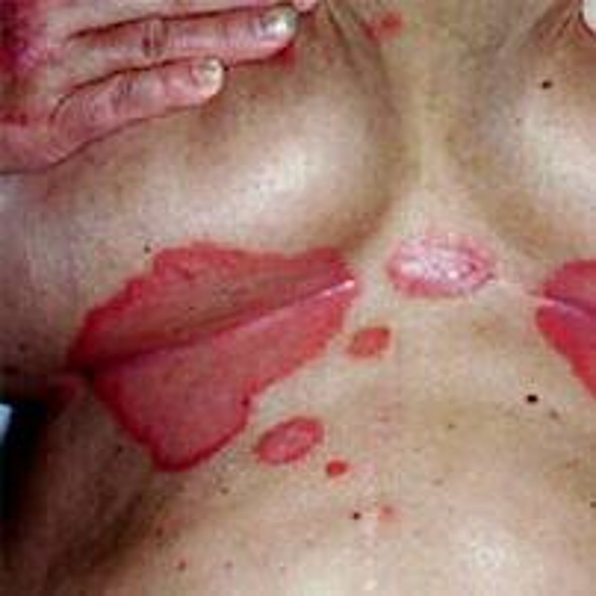 <p>diagnose this image:</p><p>this presents as bright red, waxy-looking, sometimes weeping, w/ minimal scale seen in intertriginous areas</p>