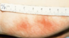 <p>Pressure Ulcer Stage</p><ul><li><p><strong>Intact skin</strong> with <strong>non-blanchable redness </strong>of a localized area usually over a bony prominence</p></li><li><p>Darkly pigmented skin may not have visible blanching; its color may differ from the surrounding area</p></li></ul><p></p>