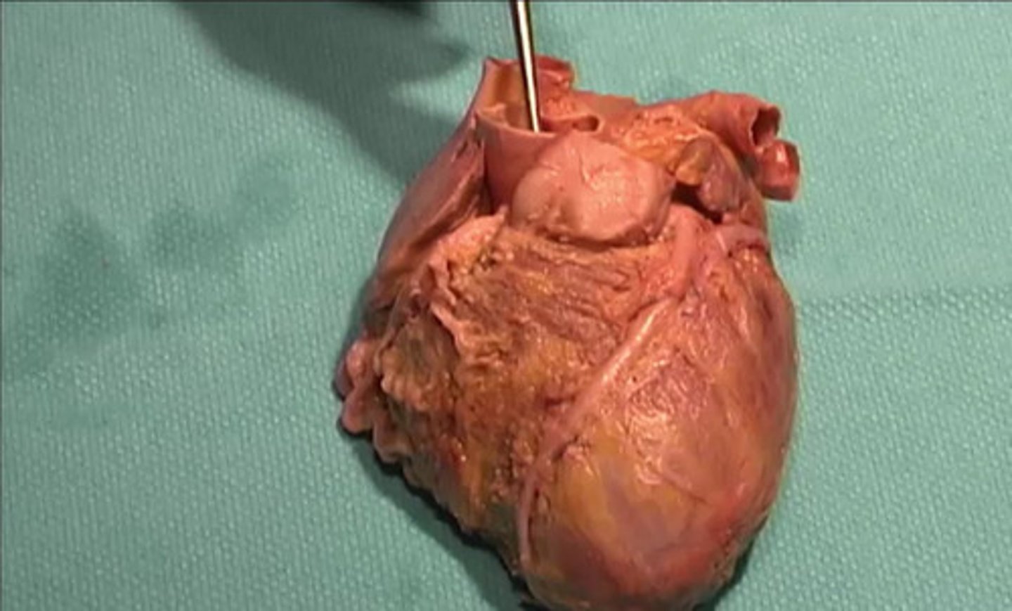 <p>What structure is being represented by the metal pointer?</p><p>Pulmonary Trunk</p><p>Superior epigastric artery</p><p>Aorta</p><p>Superior Vena Cava</p>