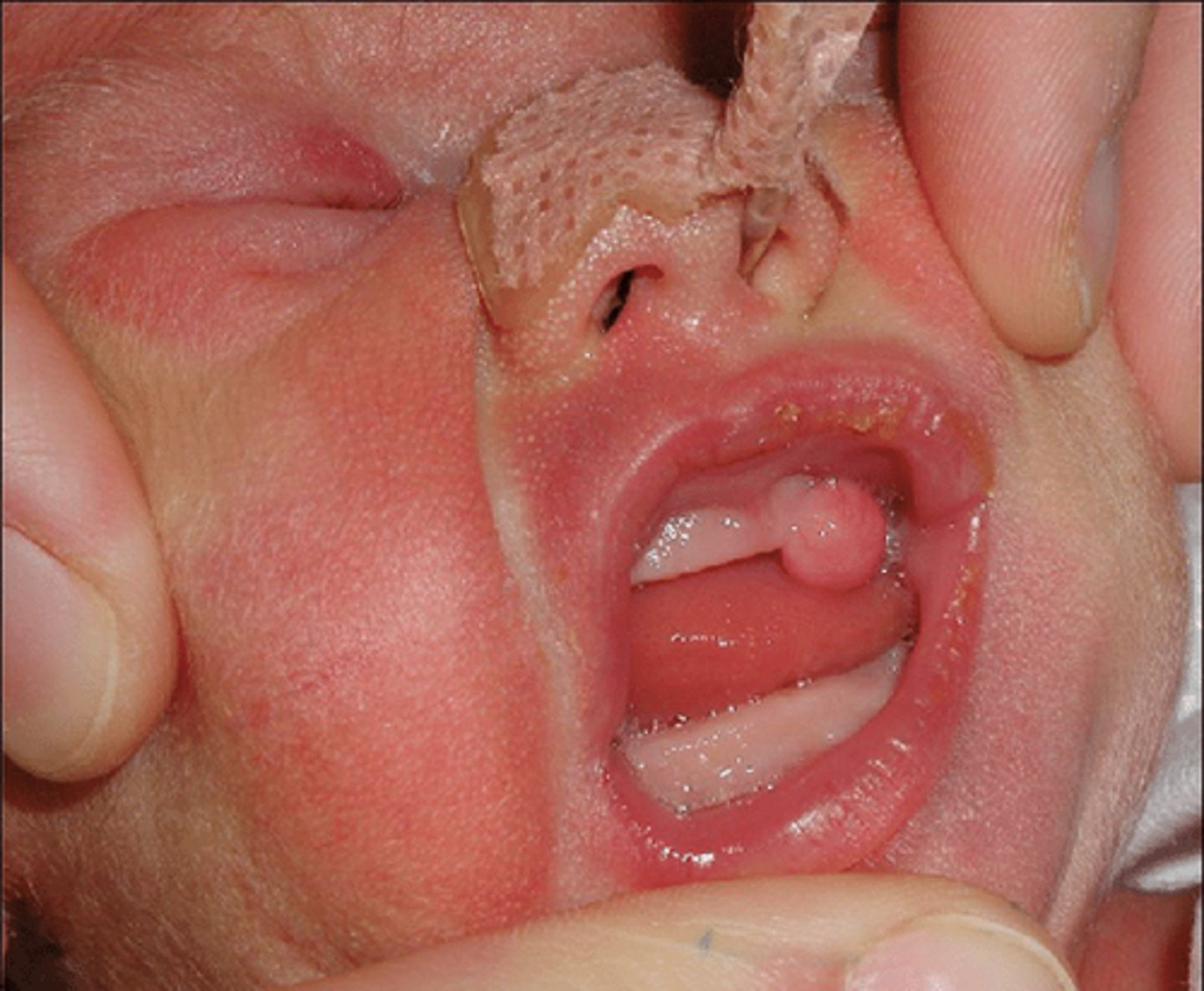 <p>3 week old female patient presents with a nodular formation on the maxillary gingiva lateral to the midline. Histopathology showed cells with granular cytoplasm resemble granular cell tumors. NO pseudoepitheliomatous hyperplasia were present. What do you suspect?</p>