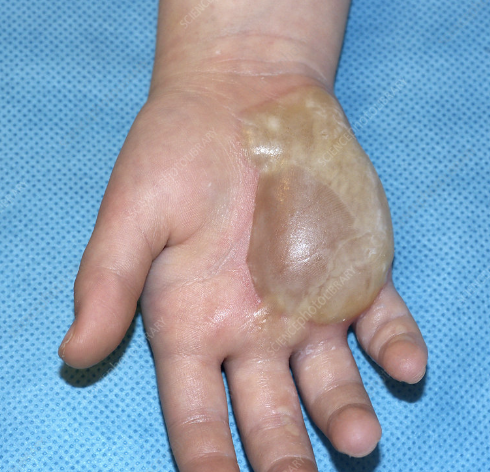 <p>Primary Skin Lesion</p><ul><li><p><strong>Fluid-filled</strong> lesion of <strong>more than 0.5 cm</strong></p></li><li><p>E.g., large burn blister</p></li></ul><p></p>