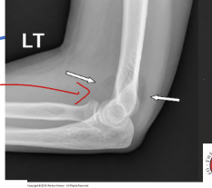 <p>What does inflammation of the fat pad on the elbow indicate?</p>