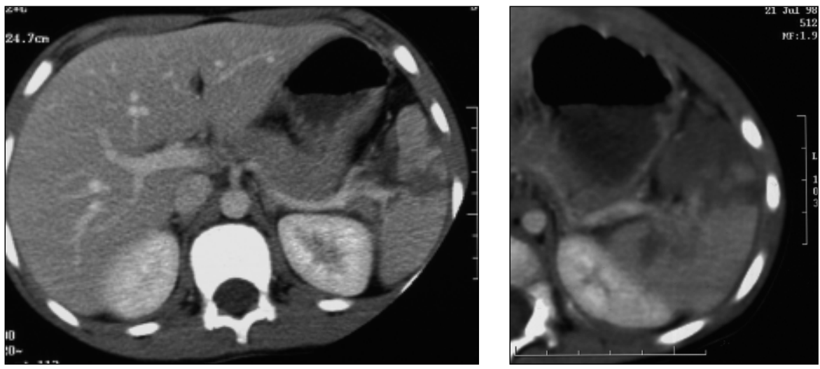 <p>What is shown in this CT image?</p>