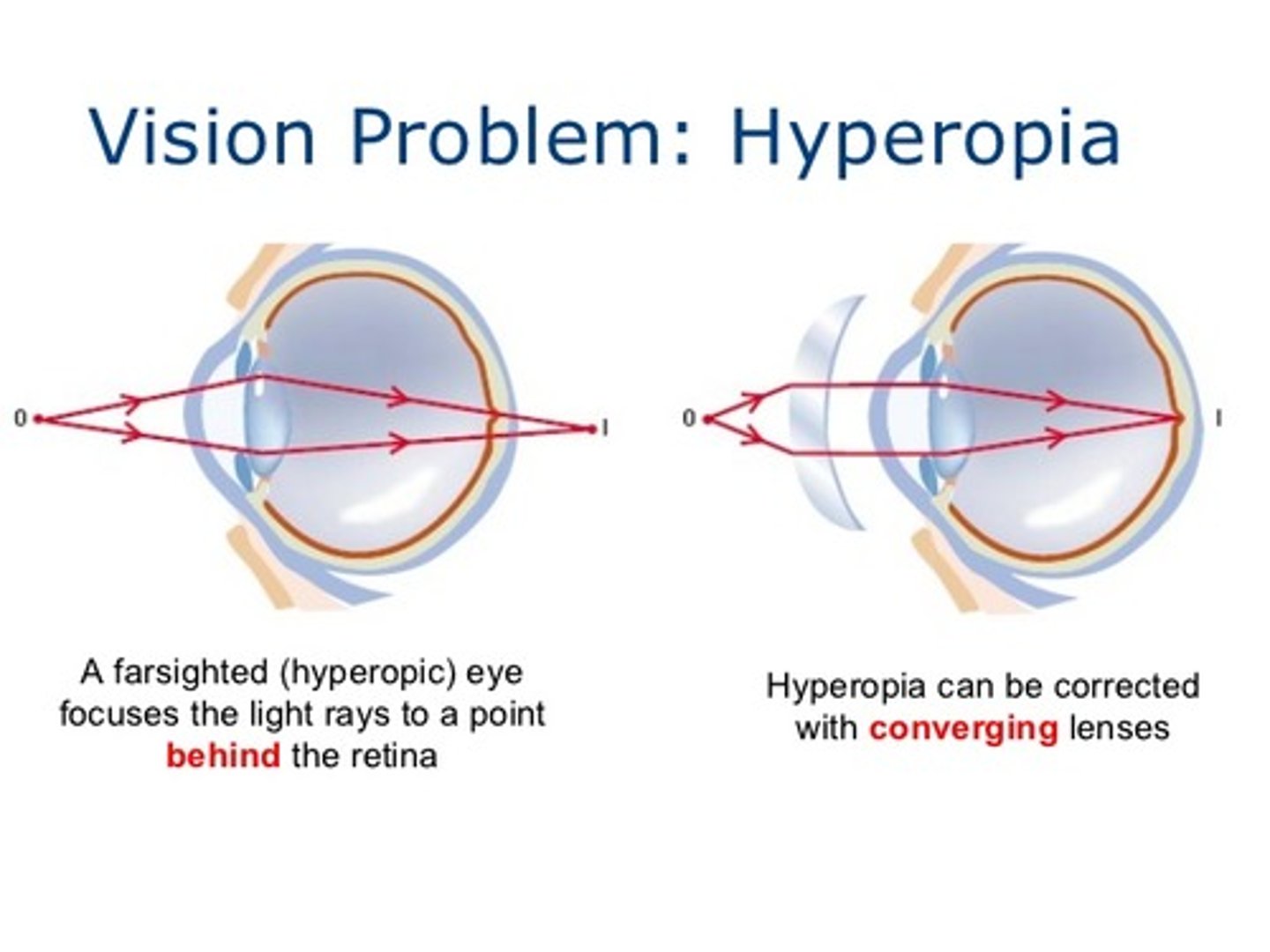 <p>(B) behind, convex</p><p>A person who is farsighted will form the image behind their retina and should be prescribed a convex lens.</p>