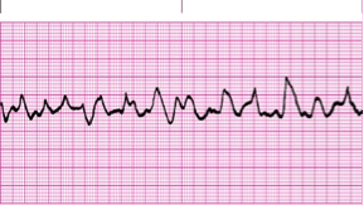 <p>What is this rhythm and how is it treated?</p>