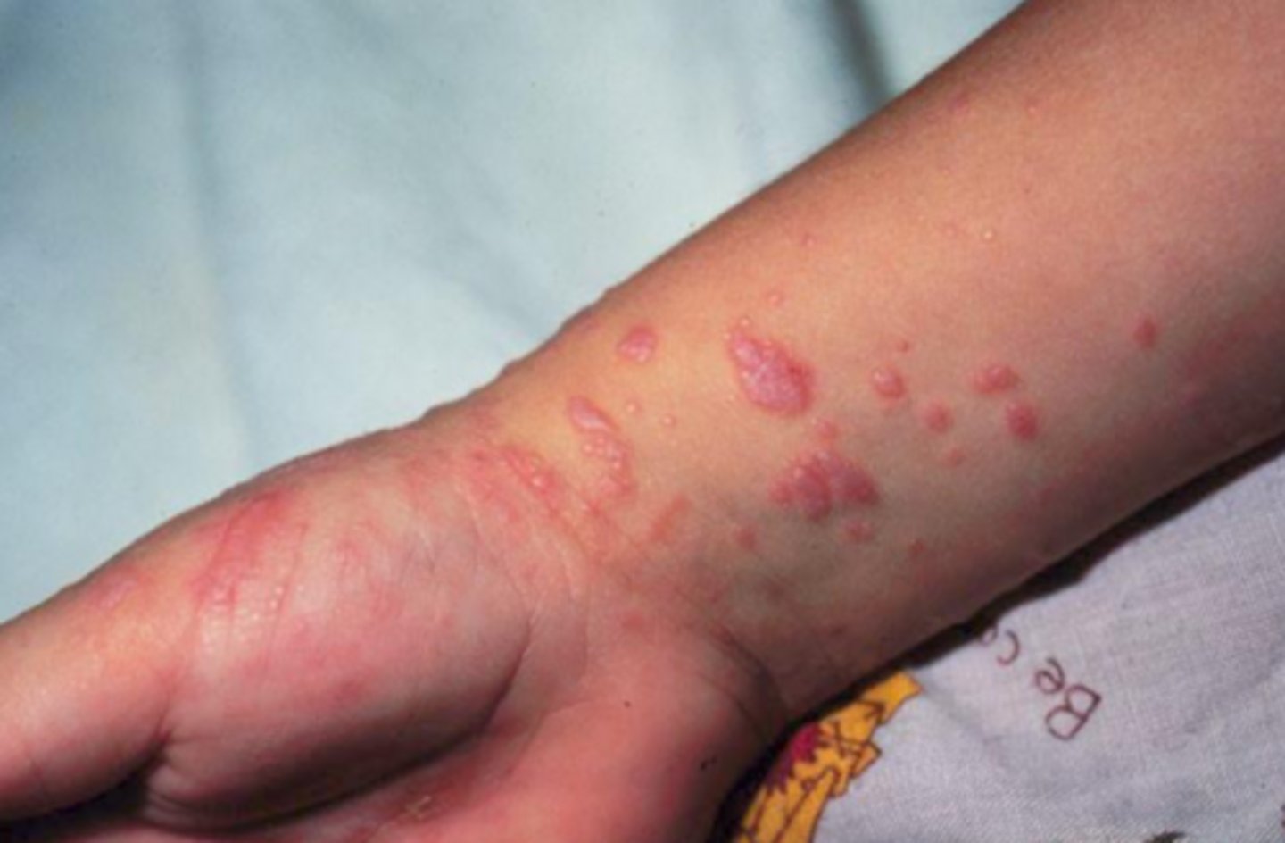 <p>erosive lichen planus</p>