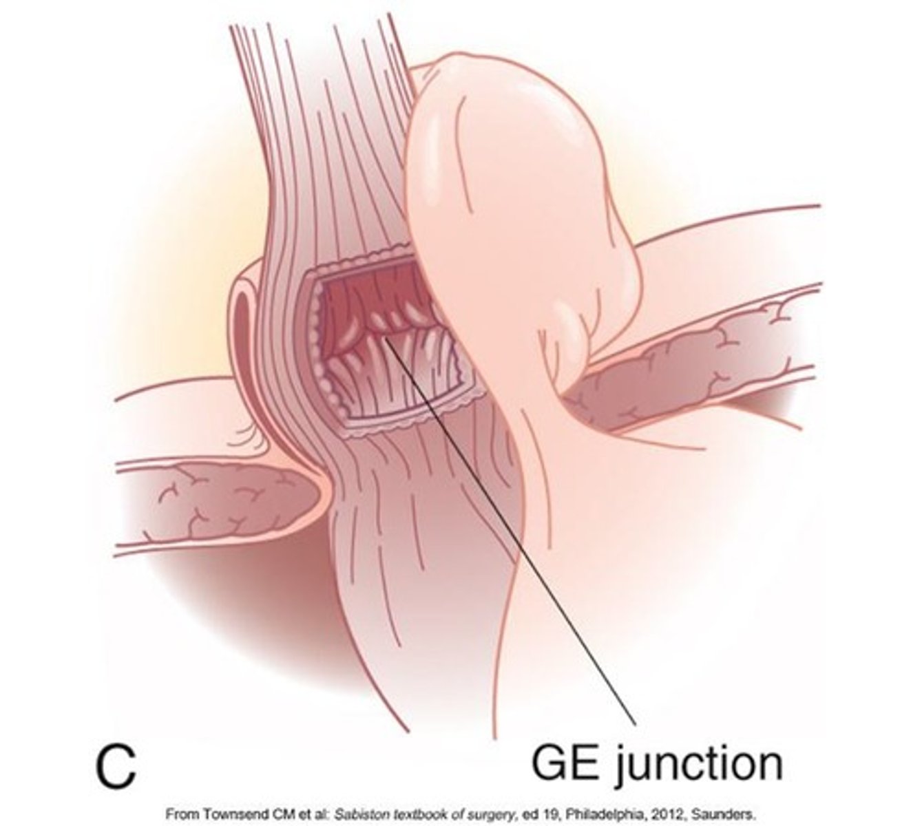 <p>Discomfort occurring 10-15 seconds after swallowing.</p>