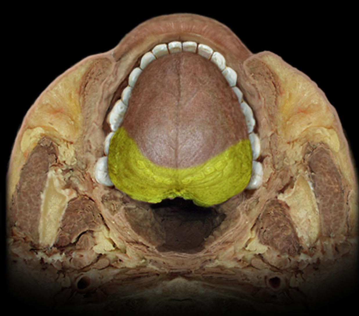 <h4 collapsed="false" seolevelmigrated="true"><strong>Location:</strong></h4><ul><li><p>Posterior 1/3 of tongue (information from taste buds)</p></li></ul><h4 collapsed="false" seolevelmigrated="true"><strong>Comment:</strong></h4><ul><li><p>Special sensation includes smell, vision, taste, hearing, and balance</p></li></ul>