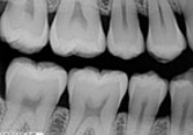 <p>A bitewing image oriented horizontally, used mainly for detecting interproximal caries.</p>