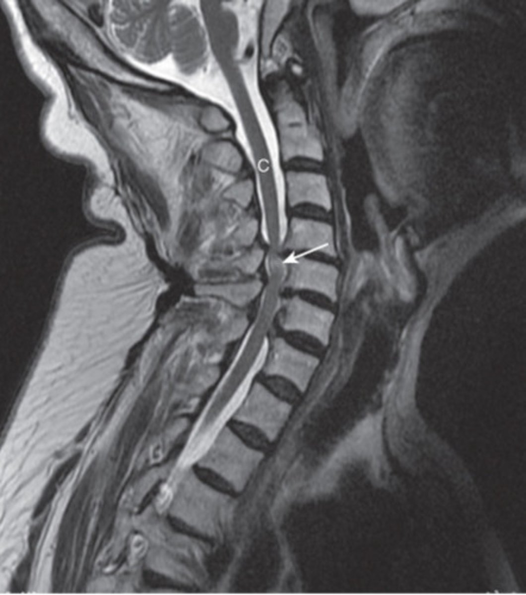 <p>degeneration of outer annular fibers, caused by acute compression of nerve root</p><p>MRI is study of choice</p>