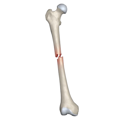 <p>What type of fracture is this? (there are closed and complex varients [if they’re inside the body still])</p>