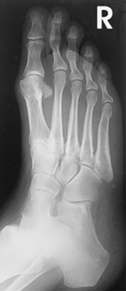 <p>- 30° to 40° medial rotation</p><p>- CR to base of third MT</p><p>- Entire foot visualized</p><p>- Third through fifth metatarsals free of superimposition</p><p>- Tuberosity demonstrated at base of fifth metatarsal</p><p>- Optimal exposure factors</p>