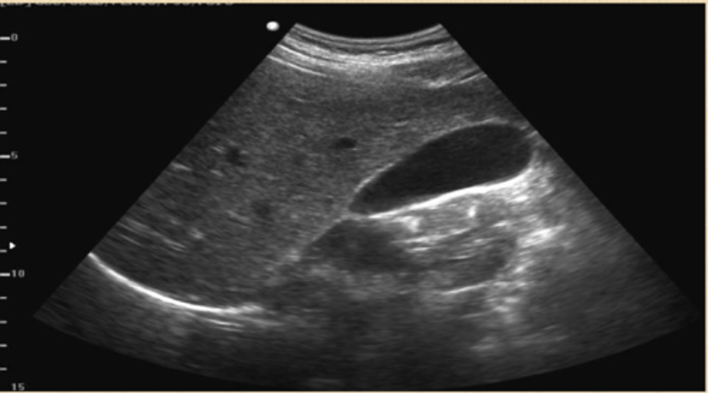 <p>xray- radiopaque gallstones</p><p>US- diagnostic study of choice, abstain from food 6 hrs before</p><p>CT- less sensitive than US in detecting gallstones, good for difficult anatomy, masses, extent of disease</p><p>HIDA scan- nuclear medicine, visualizes flow of bile</p>