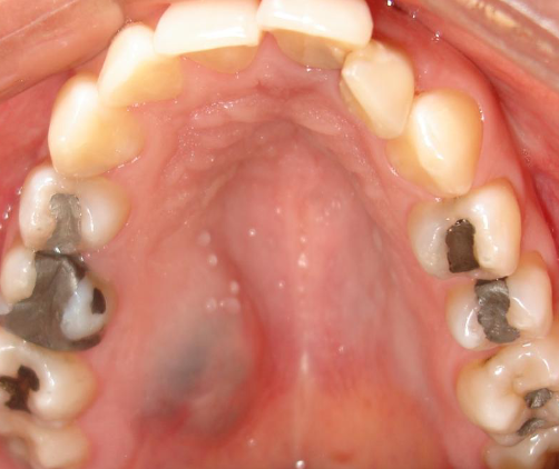 <p>salivary gland neoplasm </p>
