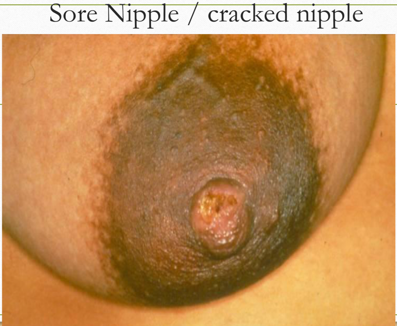 <p>Briefly explain cracked nipples in terms of </p><ul><li><p>causes</p></li><li><p>treatment </p></li></ul><p></p>