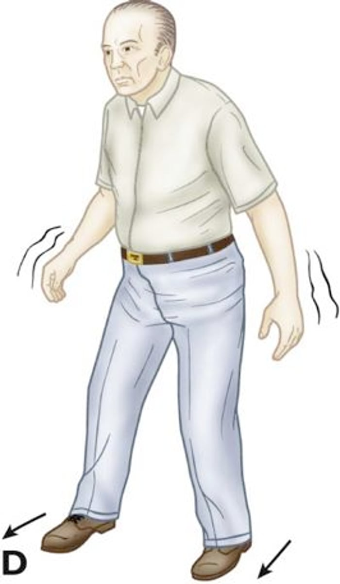 <p>staggering, wide-based gait; difficulty with turns; uncoordinated movement with positive Romberg sign</p>