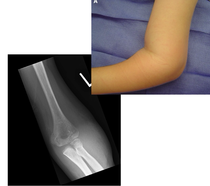 <p><span><strong>one of the most common traumatic fractures in kids 5-7yo</strong></span></p><p><span>S/S: pain, <strong>swollen</strong> <strong>elbow</strong>, limited motion; associated with anterior interosseous nerve, median or radial nerve neurapraxia, can be urgent (pulseless, check with Doppler)</span></p><p><span>Dx: XRAY AP/Lat view of elbow</span><br><span>Tx: <strong>Casting (minimally displaced);</strong> surgery (complicated)</span></p>