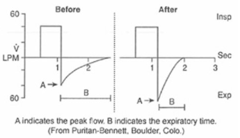 <p>A 20-year-old asthma patient is receiving mechanical ventilation on a microprocessor-type ventilator. The following graphics are noted before and after the patient is given 0.5 mL of aerosolized levalbuterol (Xopenex). How should the results be interpreted?</p><p>The patient has normal airway resistance</p><p>The medication dose is ineffective.</p><p>Suctioning is needed</p><p>The patient's bronchospasm has decreased. </p>